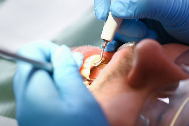 Best Emergency Dental Care for Broken or Chipped Teeth in English, IN