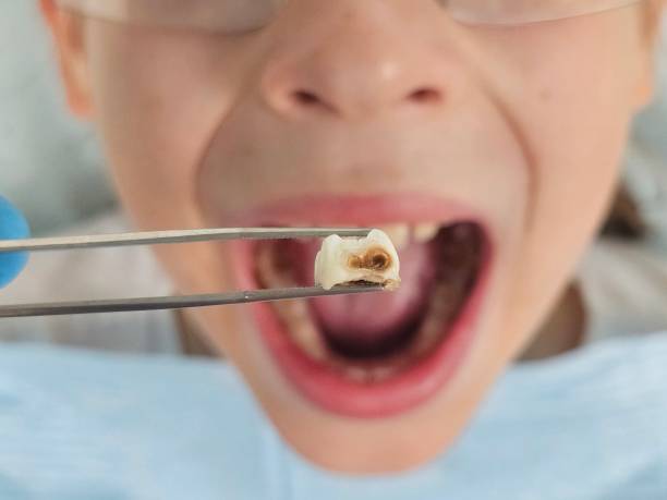 Best Urgent Care for Lost Fillings or Crowns in English, IN